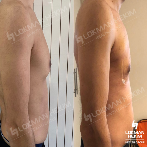 Traitement de la Gynécomastie (avec liposuccion) Photos avant & après